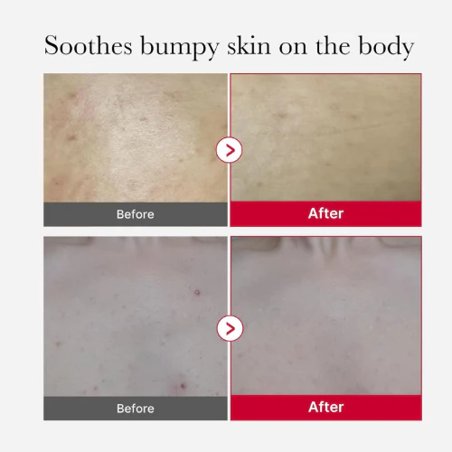 MEDICUBE RED ACNE BODY PEELING SHOT 110G – Image 2