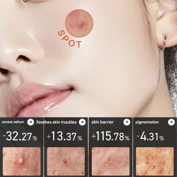 Anua Heartleaf Centella Red Spot Cream 30g – Image 3