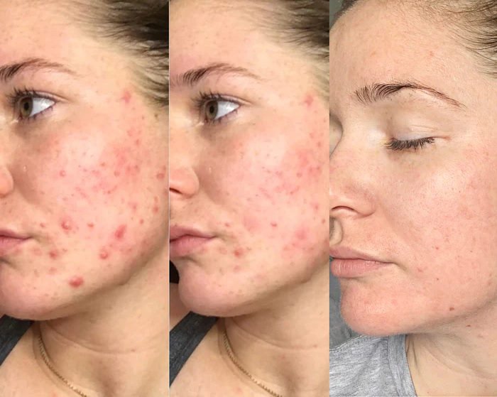 Acne-Treatment-Azelaci-Acid-Before-After